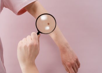 Popunjeni svi termini za besplatne preglede madeža