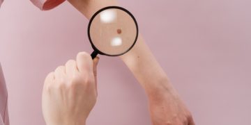 Popunjeni svi termini za besplatne preglede madeža