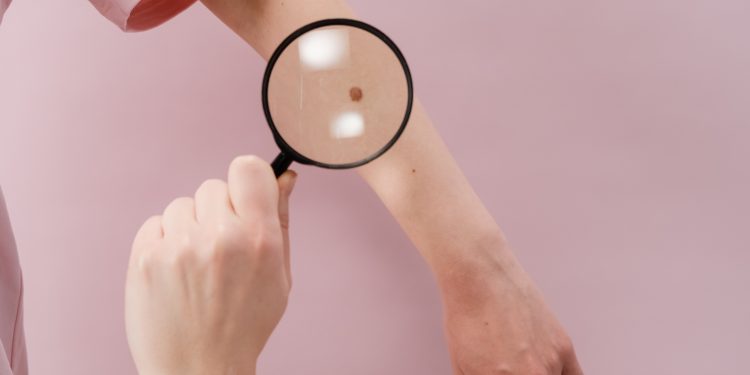 Popunjeni svi termini za besplatne preglede madeža